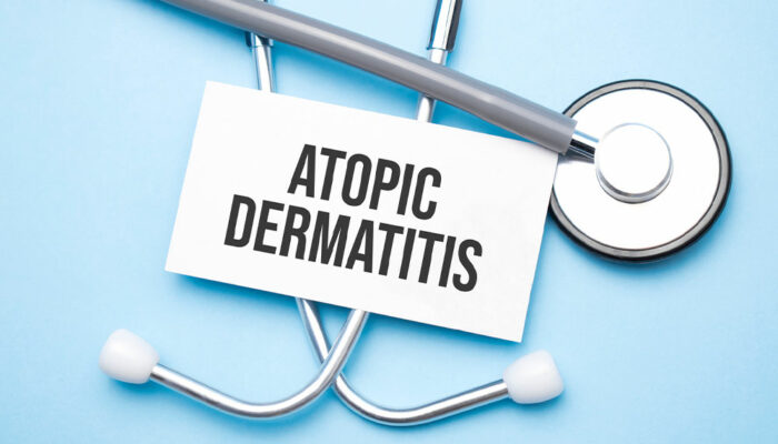 Atopic dermatitis – Symptoms and management tips