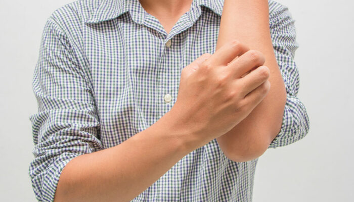 Eczema – Types, symptoms, causes, and management