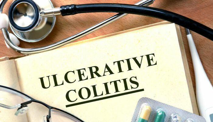 Simple tips for managing ulcerative colitis