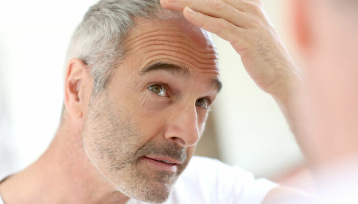 Hair loss – Types, causes, and foods that promote healthy growth