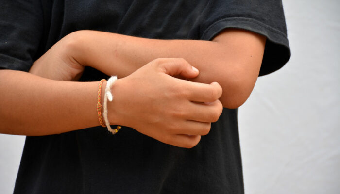 Prurigo nodularis – Causes, symptoms, and management