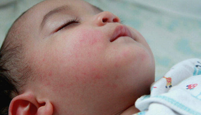 Eczema in babies, kids, and teens – Signs and management