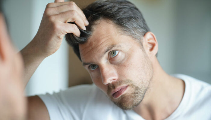 9 Medical Conditions That May Trigger Severe Hair Loss