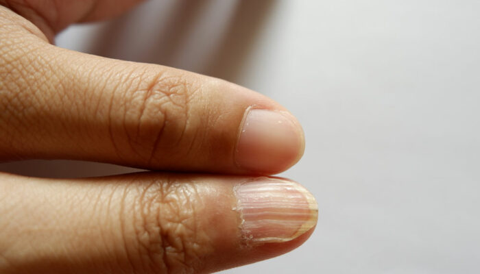 11 noticeable signs of iron deficiency in the body